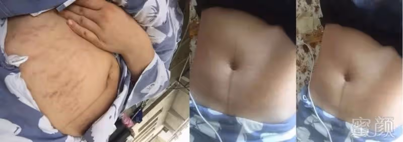 2胎都是雙胞胎,寶媽束腰扣不上看著妊娠紋無奈,網友心疼:做媽媽太不容易了