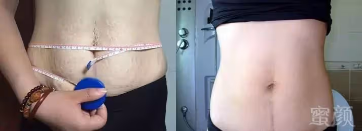 2胎都是雙胞胎,寶媽束腰扣不上看著妊娠紋無奈,網友心疼:做媽媽太不容易了