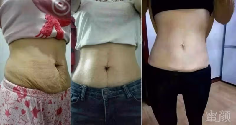 2胎都是雙胞胎,寶媽束腰扣不上看著妊娠紋無奈,網友心疼:做媽媽太不容易了
