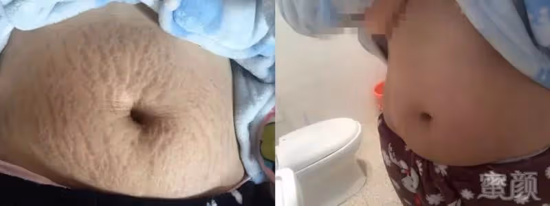 2胎都是雙胞胎,寶媽束腰扣不上看著妊娠紋無奈,網友心疼:做媽媽太不容易了