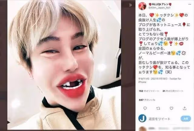 最強軟飯男!花一億整容,拔光16顆牙齒只為取樂富婆?