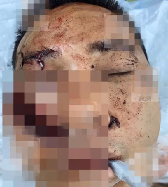 港星黃竣鋒深圳遇襲!被砍3刀急送醫縫百針,事發時多位藝人在場