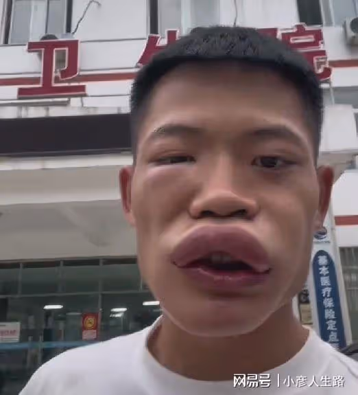 博取流量沒底線?男網紅生吃蜜蜂秒變香腸嘴,網友:建議封殺
