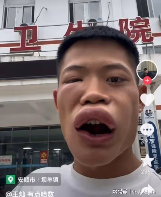 博取流量沒底線?男網紅生吃蜜蜂秒變香腸嘴,網友:建議封殺