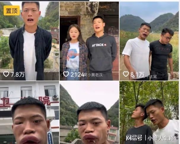 博取流量沒底線?男網紅生吃蜜蜂秒變香腸嘴,網友:建議封殺