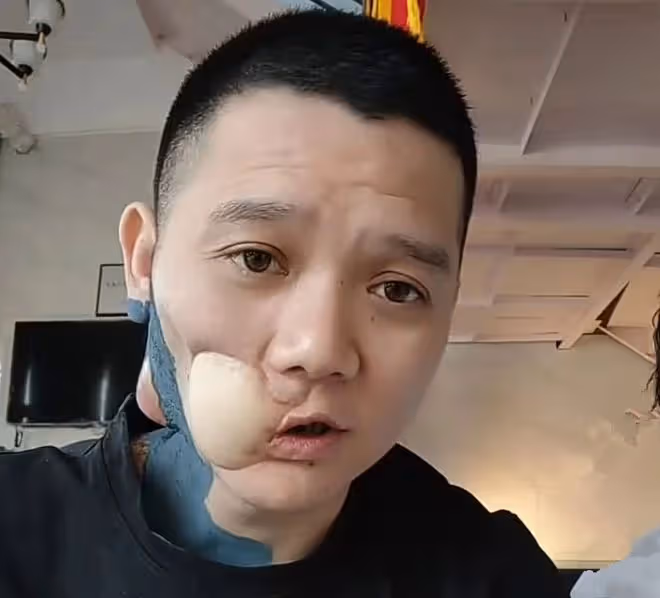 36歲歌手傅鬆口腔癌去世!生前嚼檳榔6年,最後一次露面臉部潰爛