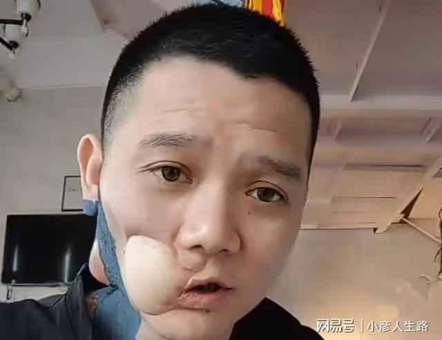 走好!36歲傅松去世,臉部潰爛自願放棄治療,曾勸網友別嚼檳榔