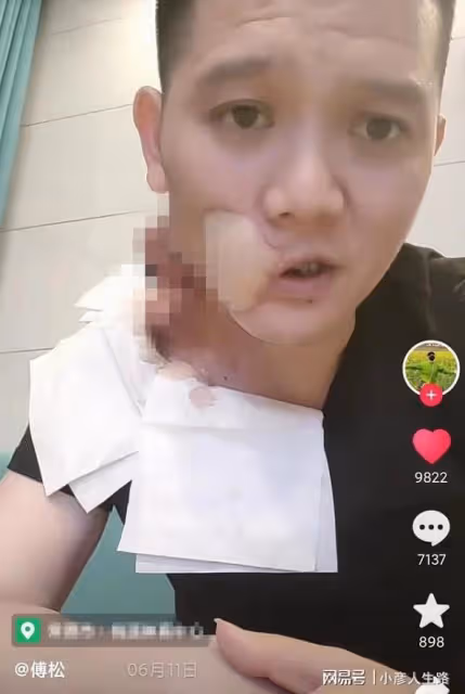 走好!36歲傅松去世,臉部潰爛自願放棄治療,曾勸網友別嚼檳榔