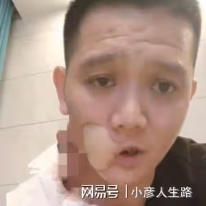36歲傅松患口腔癌去世,嚼6年檳榔成割臉人,生前最後視頻曝光