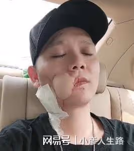 36歲傅松患口腔癌去世,嚼6年檳榔成割臉人,生前最後視頻曝光