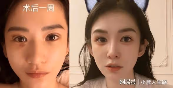 網紅灣灣整容前照片被扒,整前平平無奇,整後被指神似李多海