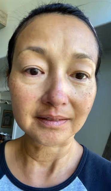 「最美郭襄」李綺紅曝近況,臉上布滿雀斑、紅疹,狀態引擔憂,本人無奈嘆息:到了更年期