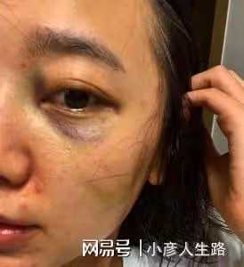 又有網紅遭家暴？徐莎朗曬受傷照，卻遭丈夫反訴多次出軌其朋友