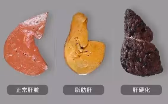 曾與劉德華合作！56歲歌手「生前滴酒不沾」因肝硬化去世　有6種跡象：要注意護肝