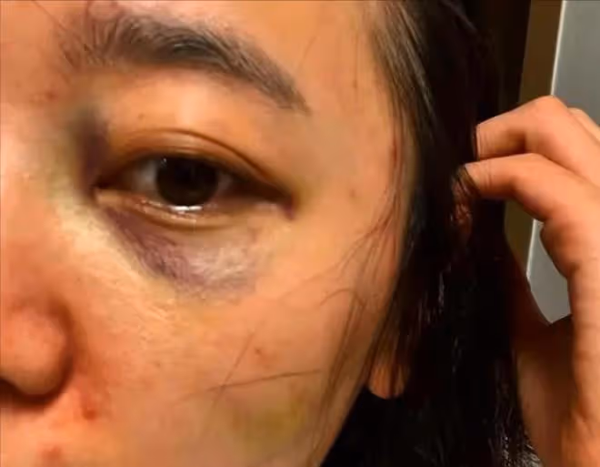 徐沙朗曬照稱遭家暴,反被丈夫控訴婚內出軌,情夫竟是老公朋友?