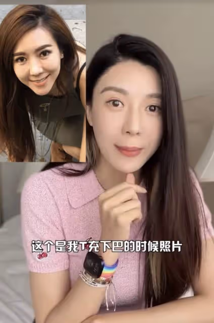 40歲女星承認整容!五官全動整完後臉腫似豬頭,自曝後遺症太嚴重