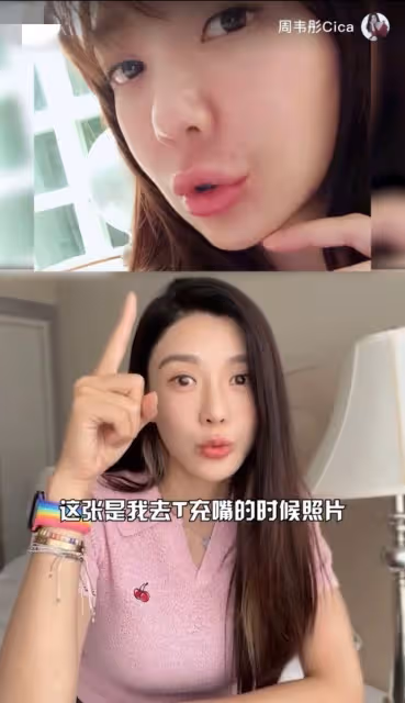 40歲女星承認整容!五官全動整完後臉腫似豬頭,自曝後遺症太嚴重
