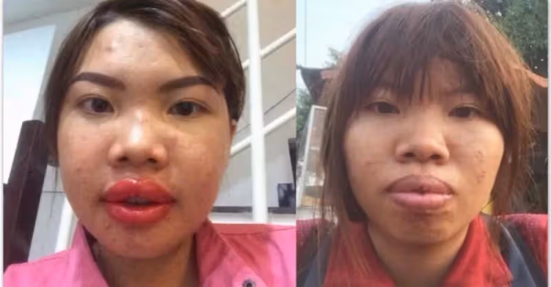 完全換臉！醜女沒人敢娶「狠花10萬整形變臉」 術後「變超美」人生大逆襲，爽嫁富二代