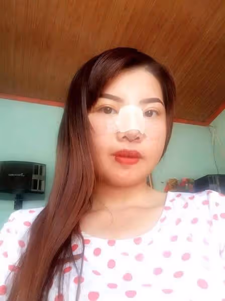 完全換臉！醜女沒人敢娶「狠花10萬整形變臉」 術後「變超美」人生大逆襲，爽嫁富二代