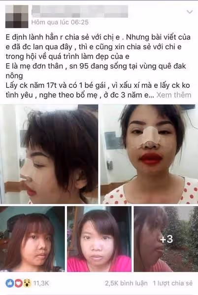 完全換臉！醜女沒人敢娶「狠花10萬整形變臉」 術後「變超美」人生大逆襲，爽嫁富二代