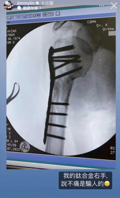 林志穎手臂X光片公開：骨頭上插滿10顆釘子，說不痛是騙人的