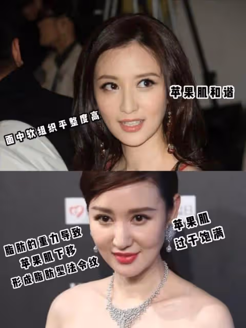 臉皮聳拉、額頭臃腫、表情僵硬，「整容」後的中年演員都翻車了