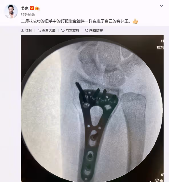 謝楠橈骨粉碎性骨折後續，手術成功後吳京神回應，鐵憨憨上線