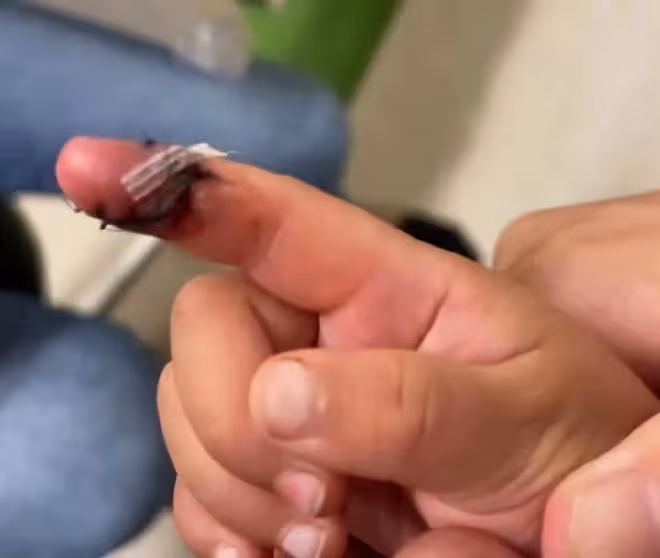 張恆曝鄭爽疑似美國虐童！兒女手指縫五針傷痕嚴重，稱害怕媽媽