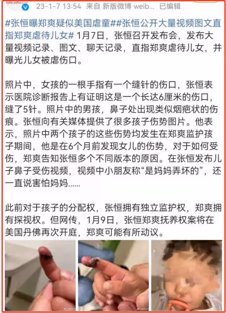張恆控訴鄭爽虐童!孩子被縫5針,身上驚現煙疤,哭訴說害怕媽媽