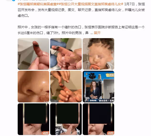張恆爆鄭爽在美國虐待孩子！公開大量照片視頻，兒女受傷嚴重縫針