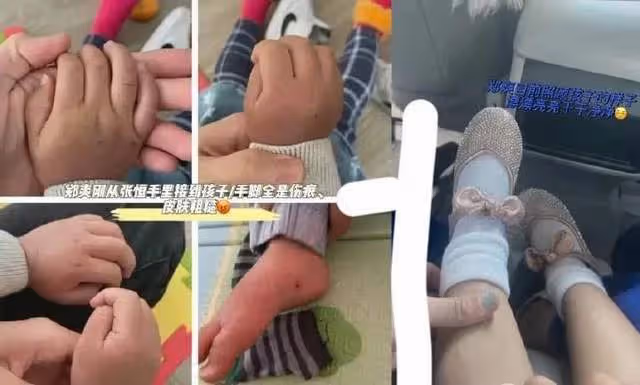 張恆控訴鄭爽虐待兒童後續，他已提起訴訟，孩子受傷照片細節曝光