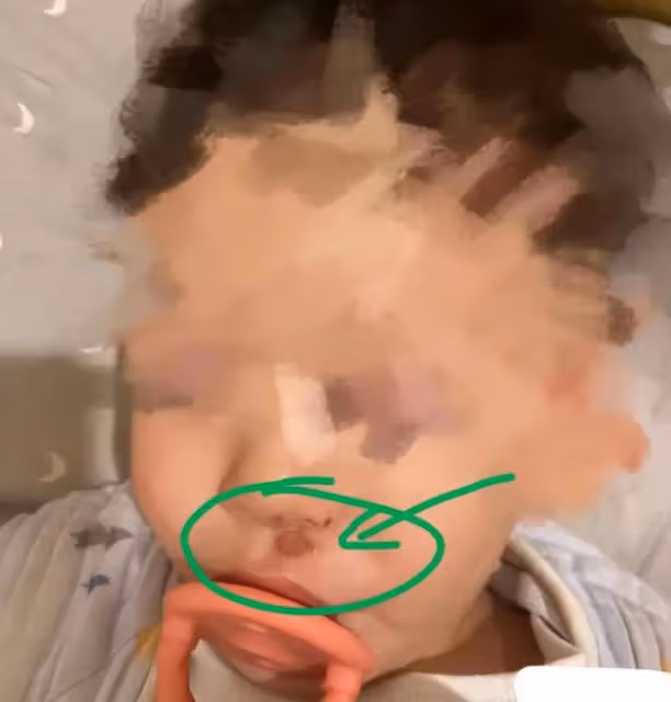 張恆控訴鄭爽虐待兒童後續，他已提起訴訟，孩子受傷照片細節曝光