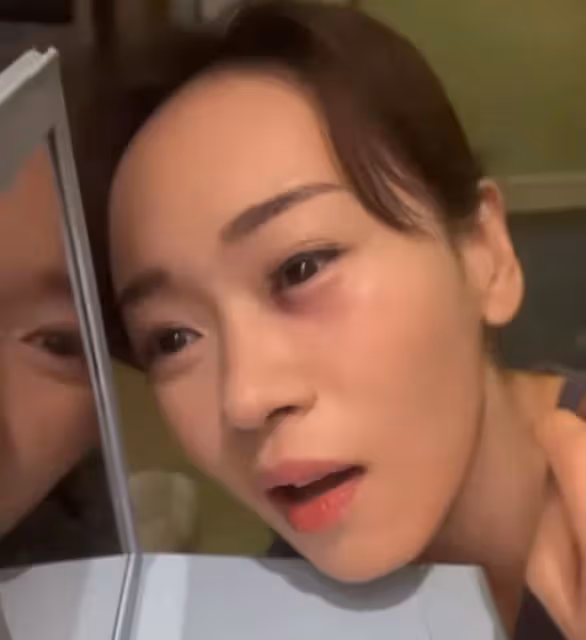 44歲港姐內地拍戲險變瞎子!被對手撞傷眼部,淤青紅腫痛到流淚