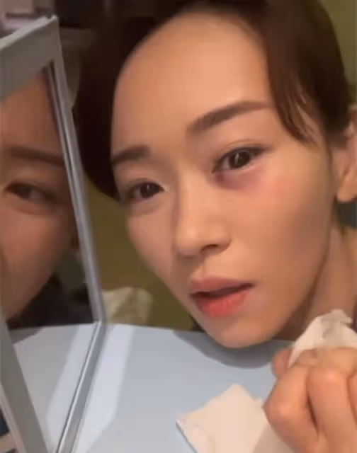 44歲港姐內地拍戲險變瞎子!被對手撞傷眼部,淤青紅腫痛到流淚