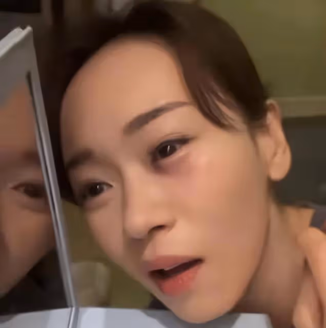 TVB前港姐冠軍拍戲受傷！眼角傷口紅腫，自曝險些變瞎子
