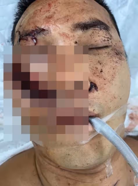 康復進度理想!香港知名男星內地遇襲重創險毀容,近況恢復光滑肌