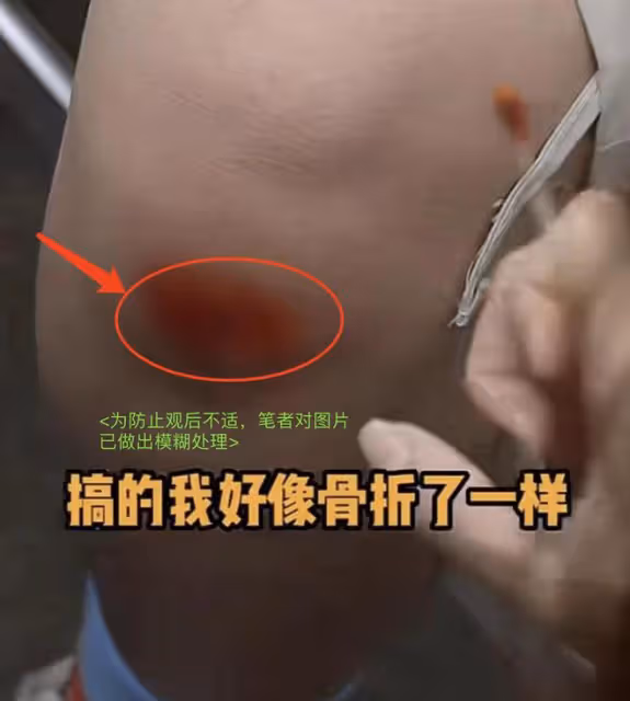 「謝飛機」曹桐睿拍戲出意外,膝蓋擦傷血肉模糊,拒絕就醫超男人
