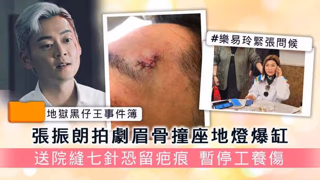 TVB演員張振朗拍戲出意外，眉骨被燈撞傷破相，送醫縫7針恐留傷疤