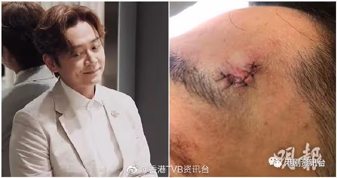 突發!TVB男星凌晨拍劇發生意外,血流如注被送入院縫7針