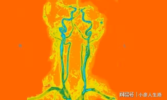 近2億國人有頸動脈斑塊！記住這4點，或可改善斑塊降低腦梗發生率