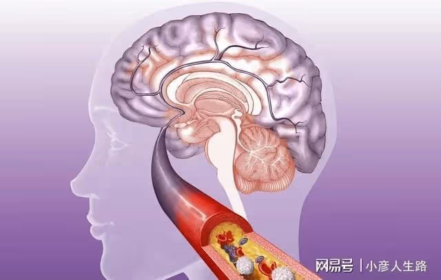 近2億國人有頸動脈斑塊！記住這4點，或可改善斑塊降低腦梗發生率