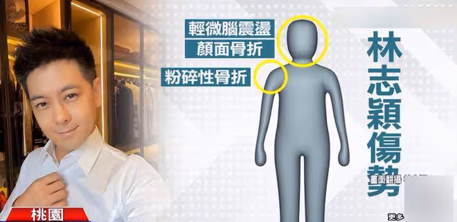 林志穎車禍後將復出,現身公司宣傳建築項目,臉頰未留疤痕無瑕疵