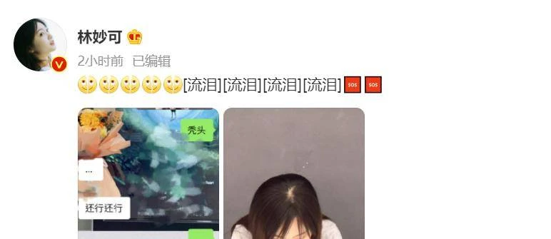 22歲童星林妙可曬禿頭照,頭頂頭髮少一大塊兒,在線發文求助網友