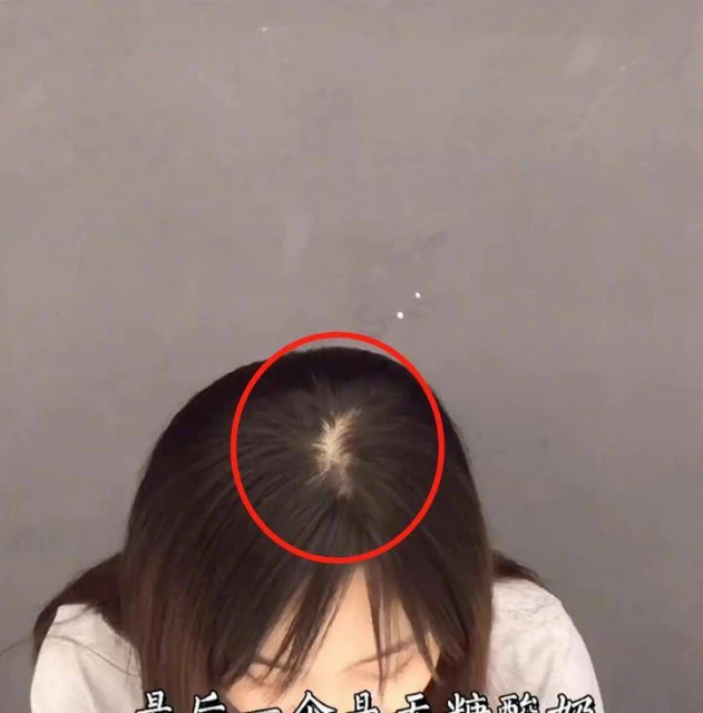 22歲童星林妙可曬禿頭照,頭頂頭髮少一大塊兒,在線發文求助網友