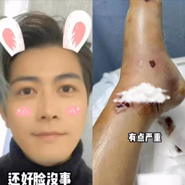 突發！陳學冬因車禍腿部受傷，多處打鋼釘無法行走，萬幸沒有毀容