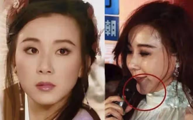 從整容臉崩,卻又奇蹟般恢復?從婁藝瀟到李金銘,都變得聰明了