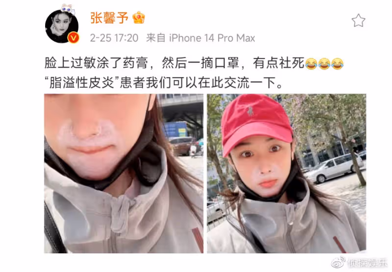 張馨予患脂溢性皮炎，臉上塗藥膏摘口罩後社死，網友打趣像熊大