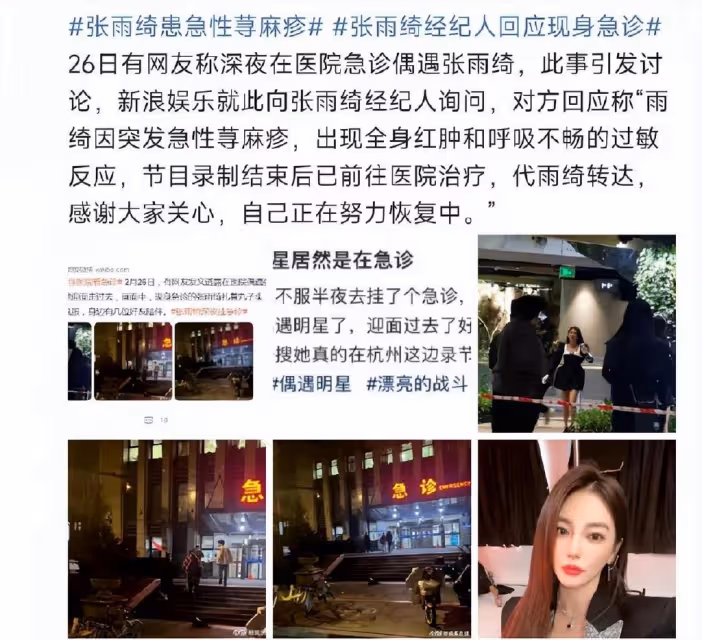 張雨綺看急診引熱議,經紀人:突發急性蕁麻疹,全身紅腫呼吸不暢