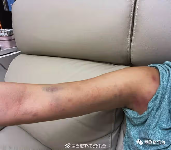 戒公主脾氣找聰明男友!TVB力捧小花身體差毛囊發炎胸前含膿