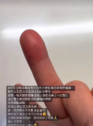 賈靜雯美國陪女兒意外受傷!手指化膿紅得發紫,被誤診忙返台求助